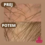 Prekomerno izpadanje las prej potem